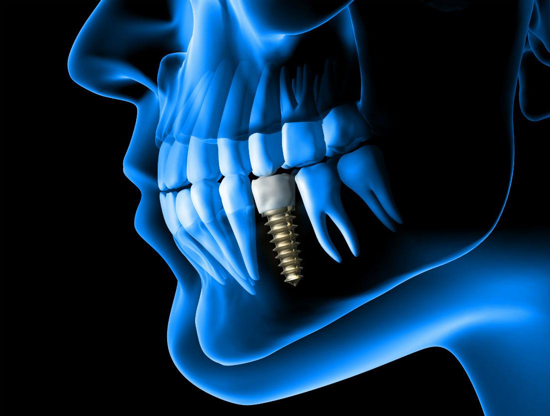 Dental Implants Woburn, MA